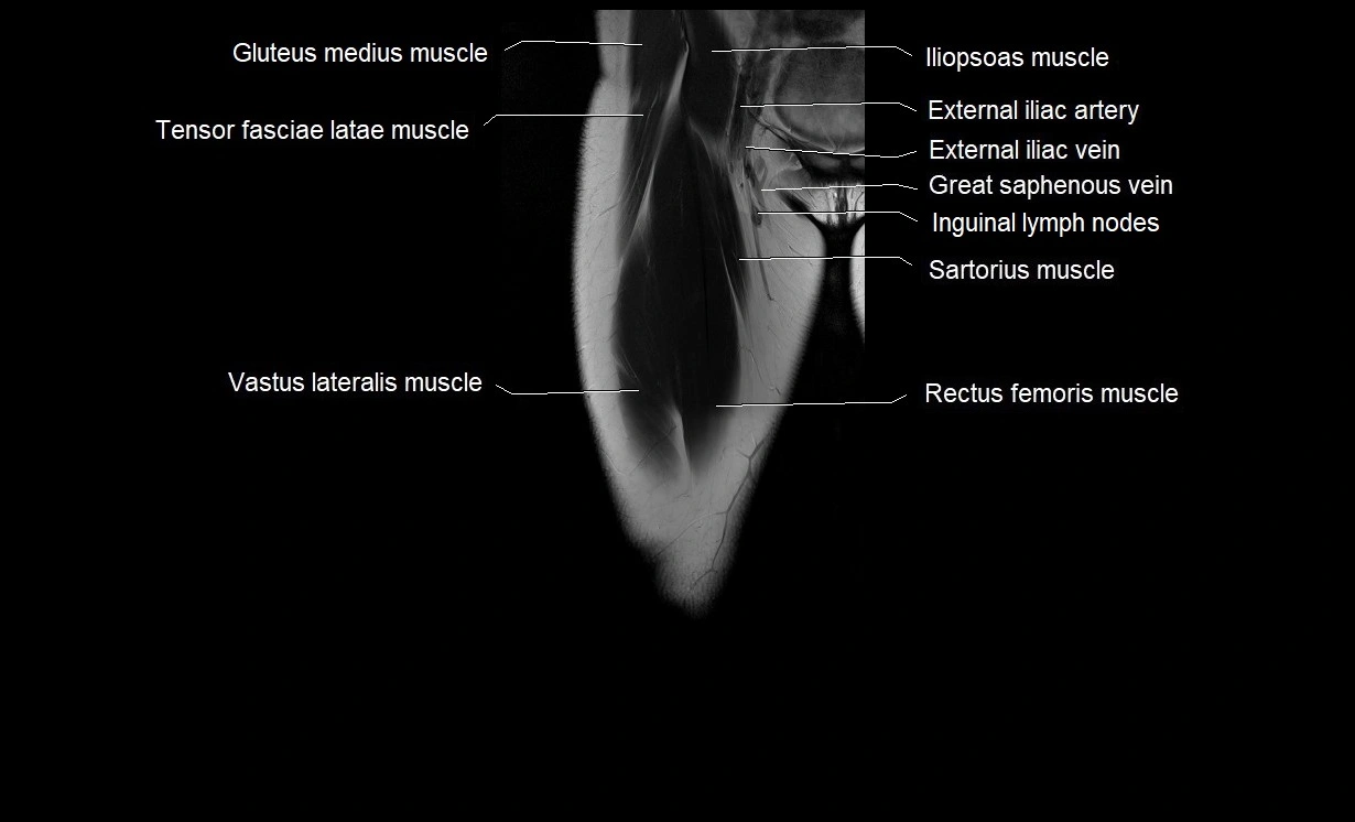 MRI thigh coronal cross sectional anatomy image 4.webp